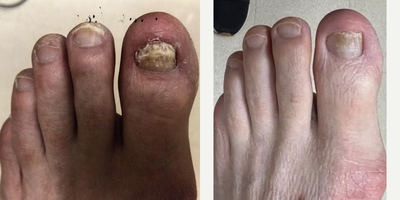 65-74 year old man treated with Laser Toenail Fungus Removal - Before and after 4 laser onych treatments to treat toenail fungus