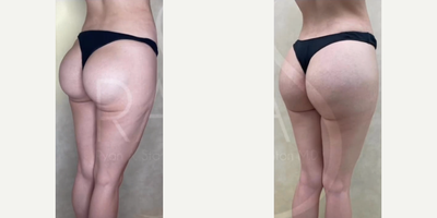 Woman treated with Butt Implants - Woman treated with Butt Implants