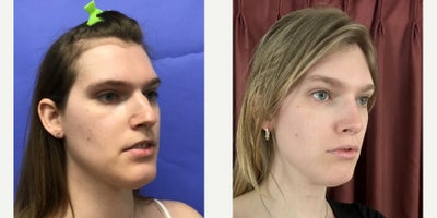 Patient treated with Forehead Reduction, Brow Lift, Septoplasty, Adam's Apple Reduction, Facial Fat Transfer - 25 to 34 year-old female patient is 1 year post-op from Facial Feminization surgery. Her procedures included:Forehead Lift, Hairline Lowering, Superorbital Bone Reduction and ContouringSeptorhinoplasty (closed) with Cartilage Grafts and WeirsChin Reduction and ContourThyroid Cartilage ShaveVoice FeminizationFat Augmentation to Lips