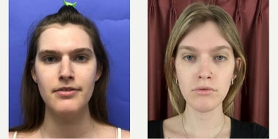 Patient treated with Forehead Reduction, Brow Lift, Septoplasty, Adam's Apple Reduction, Facial Fat Transfer - 25 to 34 year-old female patient is 1 year post-op from Facial Feminization surgery. Her procedures included:Forehead Lift, Hairline Lowering, Superorbital Bone Reduction and ContouringSeptorhinoplasty (closed) with Cartilage Grafts and WeirsChin Reduction and ContourThyroid Cartilage ShaveVoice FeminizationFat Augmentation to Lips