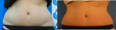 TriPollar - 
	Tummy skin tightening and fat reduction after 6 treatments. 2 cm circumference reduction. Photos supplied by manufacturer, Pollogen Ltd, All Rights Reserved.
