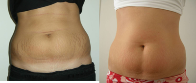 TriPollar - 
	Tummy skin tightening after 5 treatments. Photos supplied by manufacturer, Pollogen Ltd, All Rights Reserved.
