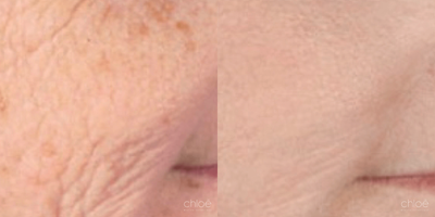 Reduce Skin Pigmentation using Microneedling - Solar lentigos, commonly called dark spots or age spots, are flat brown spots caused by sun exposure. They may be present all over the body surface, especially in the areas most exposed to UV rays. This condition can be effectively treated with microneedling.