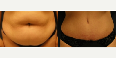 Woman treated with Liposuction - Woman treated with Liposuction as well as Tummy Tuck