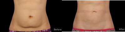 35-44 year old woman treated with Emsculpt - Emsculpt Neo is one of the best body contouring devices because it doesn't just burn fat, it helps tone your muscles to.