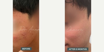 Man treated with Accutane - Man treated with Accutane