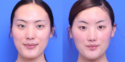 25-34 year old transgender woman treated with Facial Feminization Surgery - Frontal Browlift; Bone Rdn; Hairline Adv; Thyroplasty;AFG; Cheeks, Rhinoplasty; Lip Augment with Fascia