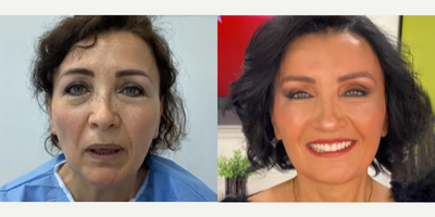 56 year old woman treated with Cheek Augmentation - 56 year old woman treated with Cheek Augmentation through facial fat transfer to face and lipsas well asDeep Plane Facelift,Neck Lift, Eyelid Surgery, Brow Lift,Buccal Fat Removal,and Cheek Lift. Patient felt very old and was concerned with the sagging of her face.