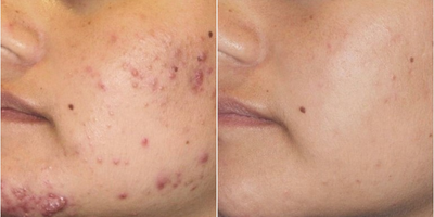 Woman treated with AviClear - Woman treated with AviClear