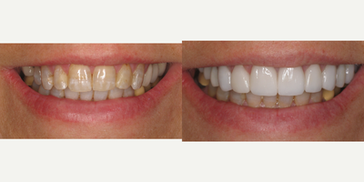 55-64 year old woman treated with Porcelain Veneers - 12 upper porcelain restorations to correct tetracycline stain, dark composite fillings, decalcification, recurrent decay, and an implant to replace a tooth that was extracted.