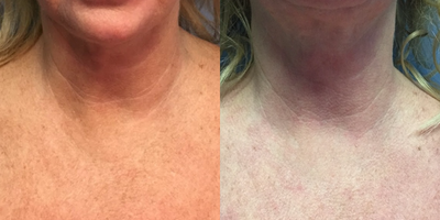 45-54 year old woman treated with Active FX - Patient saw significant improvement to her decolletage (chest) including improvements in texture, hyperpigmentation and wrinkles.