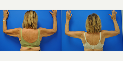 65-74 year old woman treated with Arm Lift - A brachioplasty was performed on this patient. Look at the difference in her arms! Beautiful scar too!