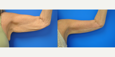 65-74 year old woman treated with Arm Lift - A brachioplasty was performed on this patient. Look at the difference in her arms! Beautiful scar too!