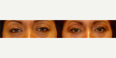 45-54 year old woman treated with Total FX - Total FX to eyelids and wrinkles
