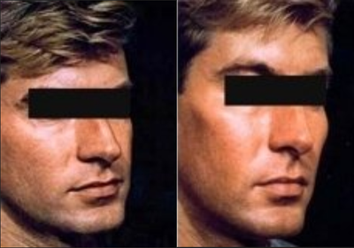 Cheek and chin Implant - Before and after cheek and chin implant