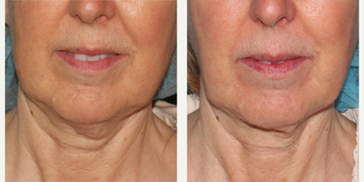 56 year old woman treated with ThermiTight - 56 year old woman treated with ThermiTight by Dr. Groff. Notice significant tightening for this non-surgical procedure