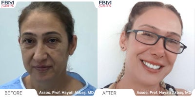 55-64 year old woman treated with Deep Plane Facelift, Double Eyelid Surgery, Rhinoplasty - 55-64 year old woman treated with Deep Plane Facelift, Double Eyelid Surgery, Rhinoplasty