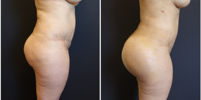 35-44 year old woman treated with Brazilian Butt Lift Revision - The patient had a previous Brazilian Butt Lift in Florida. She wanted to further improve her overall figure and increase the projection of her butt. We did a Brazilian Butt Lift Revision with SAFELipo to transform her from square to an hourglass figure. She also had fat transfer to the buttock and hips. The projection of her butt was done with 548cc butt implants. The combination of the liposculpting, fat transfer and butt implants gives her an amazing figure and butt!