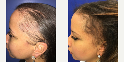 Woman treated with PRP for Hair Loss - Woman treated with PRP for Hair Loss