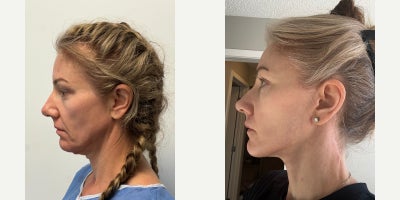 45-54 year old woman treated with Facelift - Face and Neck LiftAnterior PlatysmaplastyTemporal liftingBlepharoplasty