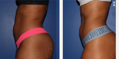 18-24 year old woman treated with truSculpt iD - Trusculpt on the abdomen