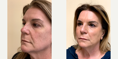 55-64 year old woman treated with Contour Thread Lift - PDO threads stimulate collagen and aims to lift, reshape, and redefine the contour of the face, brows, eyes, jawline, jowls, and cheek areas.