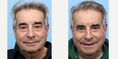 65-74 year old man treated with Eyelid Surgery, Double Eyelid Surgery - 66-year-old patient complained very puffy under eyes with bags and saggy upper eyelids that he felt were making him look tired and older. Dr. Wise performed both a lower blepharoplasty with fat removal, along with an upper blepharoplasty. Before and 2 months post-operative photos are shown, with more youthful, yet natural, results.