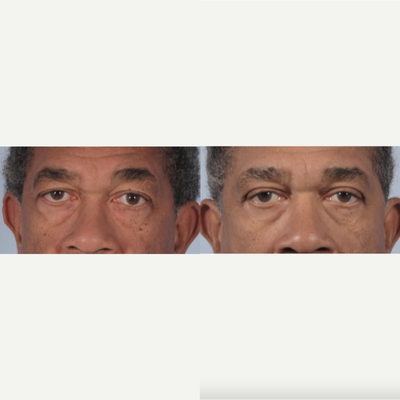 Upper blepharoplasty in a man - Dr. Kotlus performed an upper eyelid lift (blepharoplasty) with internal browpexy to prevent downward movement of the eyebrows.