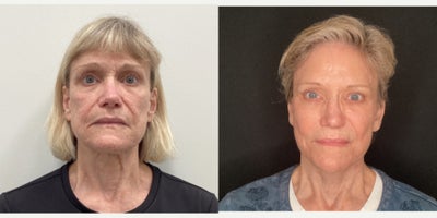 65-74 year old woman treated with Facelift Revision, Facial Fat Transfer, Fractional Laser, CO2 Laser - This patient wasn't satisfied with the results of her first facelift done by another surgeon. Dr. Lee performed a revisionary facelift with fat grafting and fractionated co2 laser resurfacing. The patient is very happy with her results.