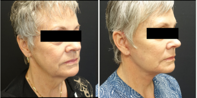 55-64 year old woman treated with SMAS Facelift - Patient underwent a high lateral SMAS face and neck lift with platysma band plication and facial fat grafting.  The combination of all these techniques give her a dramatic difference in her neck while still maintaining a natural appearance to the face overall.  The fat grafting restores the volume that patients lose over time as they age. The combination of the fat transfer and facelift give patients a more natural and youthful appearance.