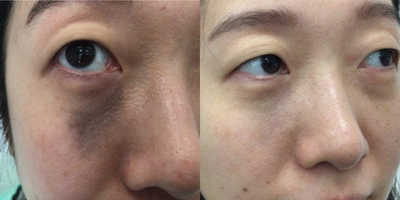 35-44 year old man treated with PicoSure - 37 year old man treated with 5 picoplus laser treatments. Nevus of Ota birthmark was initially treated with two ruby lasers and no improvement. Almost complete removal with five picoplus laser treatments.