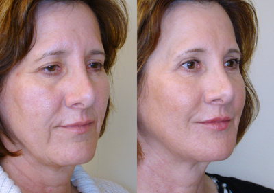 Active FX Treatment - The patient underwent Active FX procedure on her face and neck. We maintain the results with Botox and Juvederm injections.&nbsp;