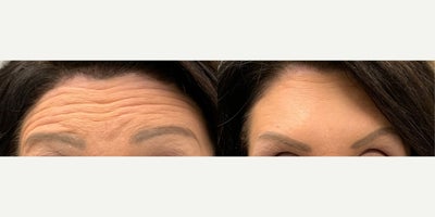 55-64 year old woman treated with Botox for Migraines, Botox - Treated by Aubrey Houchin