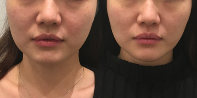 25-34 year old woman treated with Thermage FLX - age 25-34 years old woman treated with Thermage FLX on lower face