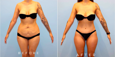 Woman treated with Breast Reconstruction - Woman treated with Mommy Makeover through Tummy Tuck, Liposuction to flanks, and Breast Reconstruction to address capsular contracture.