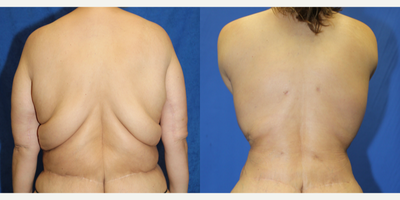 45-54 year old woman treated with Back Lift - Meet a 51-year-old white female patient who weighed 324 pounds and underwent RNY gastric bypass, resulting in an amazing transformation as she lost 126 pounds. However, she was still not happy with the excess skin and fat in her back and sides, so she decided to seek help from Dr. J. Timothy Katzen of Beverly Hills, California. He performed a vertical torsoplasty and liposuction procedure which gave her back her desired figure. She is thrilled with the results and no longer has any worries about her body image.