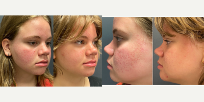 17 or under year old woman treated with ResurFX - This patient was treated for acne scarring. This is after two treatments of Resurfx and the results are incredible.Downtime after the treatment is approximately 4-5 days. Swelling and redness will subside in 24-48 hours.