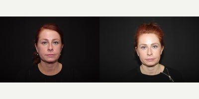 35-44 year old woman treated with Sculptra Aesthetic - 41 year old female received 2 vials of Sculptra to the temples and zygo arch; photos depict the patients results 4 months post-op.