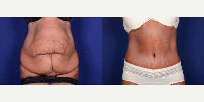 Body Lift - Body Lift