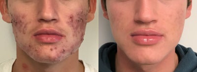 Accutane Treatment - 3 months into Accutane treatment