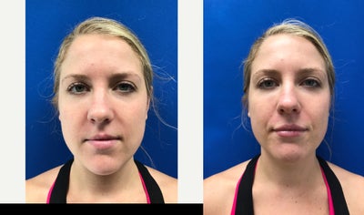 25-34 year old woman treated with Lip Augmentation - There are many shapes and sizes of lips. The key is to find a surgeon you trust that can give you what you want. It is not often I ask patients for photos of celebrities but for lips I like it when they bring me a goal! I like the challenge!Best,DrC