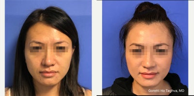 35-44 year old woman treated with Thread Lift - Non-surgical face threadlifting