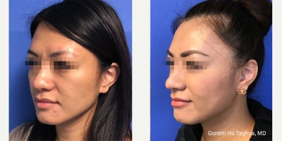 35-44 year old woman treated with Thread Lift - Non-surgical Face Thread-lifting