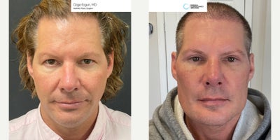 35-44 year old man treated with Chin Implant, Jaw Implants, Rhinoplasty - Chin & Jaw Implant, Rhinoplasty Surgery