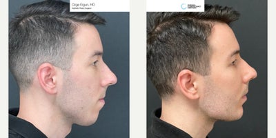 25-34 year old man treated with Chin Implant, Jaw Implants - Chin & Jaw Implant Surgery