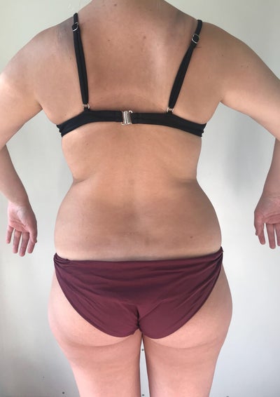 Plus size: Extended Tummy tuck with lipo on flanks - Review - RealSelf