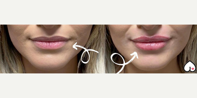 Woman treated with Restylane Kysse - Woman treated with Restylane Kysse