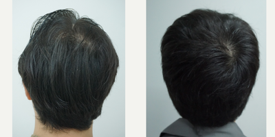25-34 year old man treated with DHI Hair Transplant, FUE Hair Transplant, Hair Transplant - A middle-aged Asian man came in for a FUE hair transplant with 3,300 grafts to restore his frontal, temples and crown. We also add more grafts on his right temple to cover his surgical scar.
