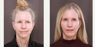 55-64 year old woman treated with MACS Facelift, Chin Implant, Eyelid Surgery - Macslift, Chin Implant, & Upper Blepharoplasty