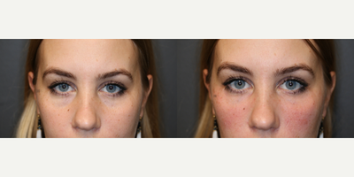 25-34 year old woman treated with Restylane Silk - Tear trough filler and cheek augmentation with cannula.